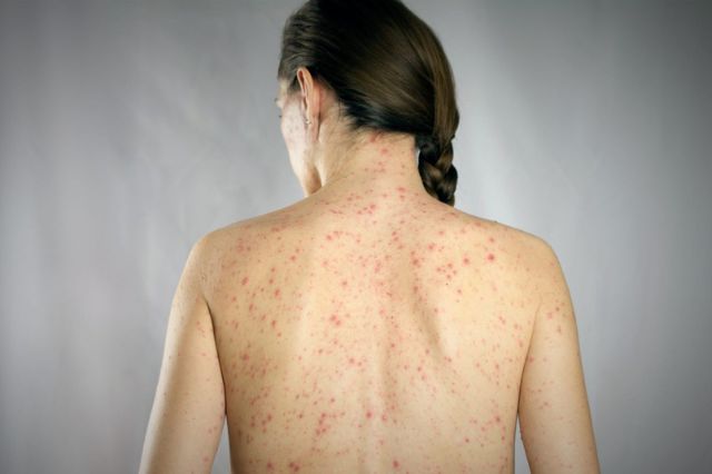 México, primer lugar en muertes por sarampión en América: OPS