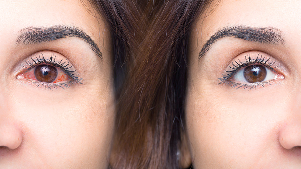 Conoces el Síndrome de Sjögren, cuando los ojos y la boca se secan