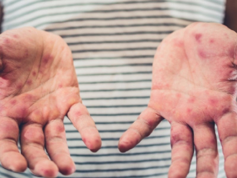 Preescolar del Centro Escolar de Izúcar, en alerta por brote de coxsackie