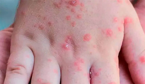 Suman 17 casos de Coxsackie en el Centro Escolar de Izúcar