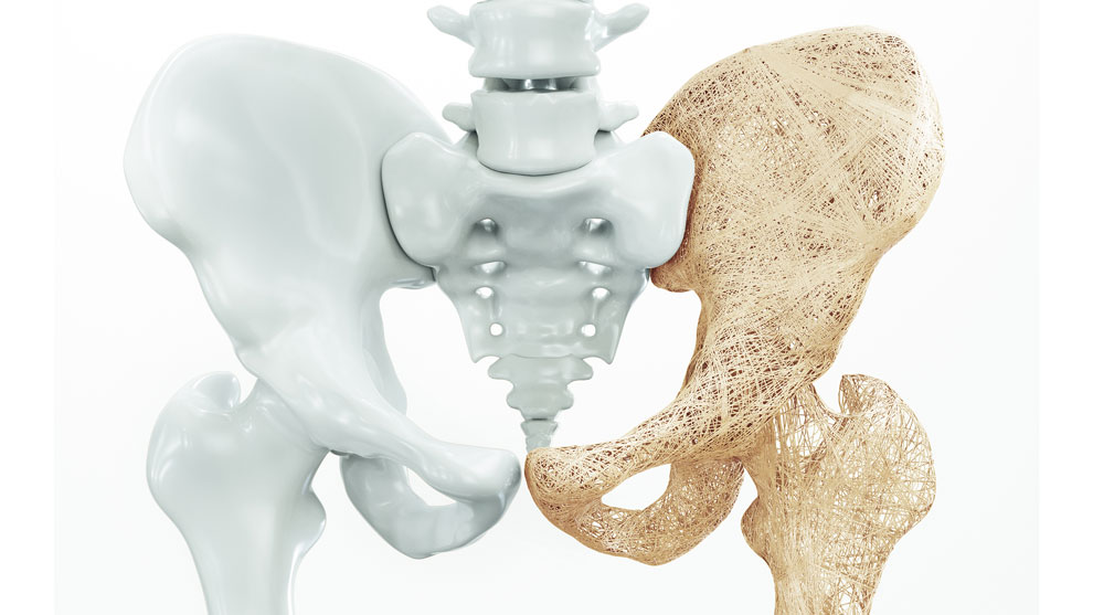 Día Mundial de la Osteoporosis, una enfermedad silenciosa que debilita los huesos