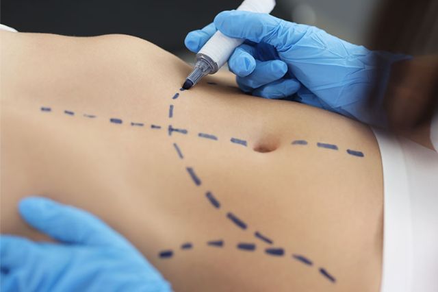 Ley Nicole: qué prohíbe y qué sanciona en cirugías estéticas a menores