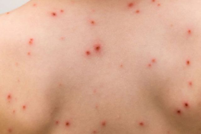 México registra más de 5 mil contagios de sarampión y 23 muertes