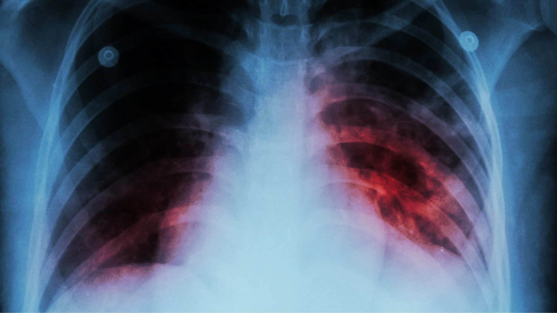 Ecosur alerta por la alarmante alza de casos de tuberculosis en todo México 