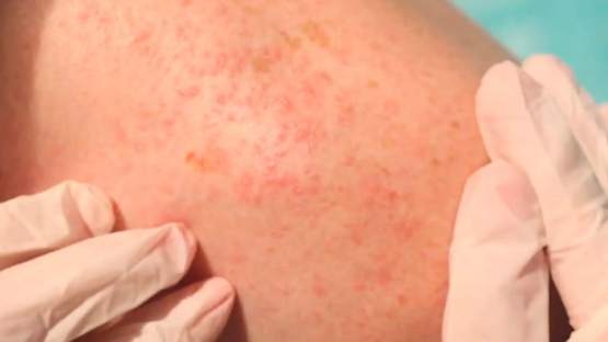 Autoridades sanitarias de Chiapas piden suspender actos masivos ante alza en casos de sarampión