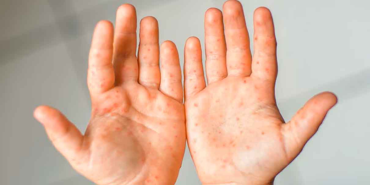 Persisten casos de Coxsackie en municipios poblanos 