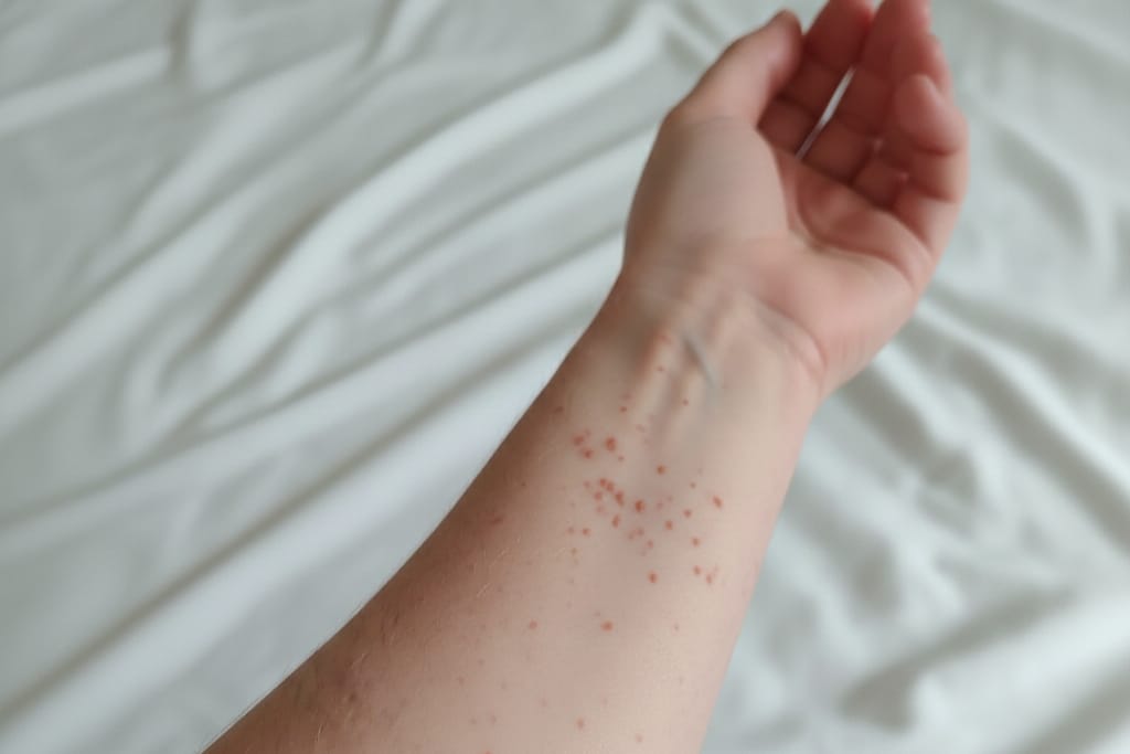 Brote de contagio de sarampión en Tlaxcala llegaría a Puebla