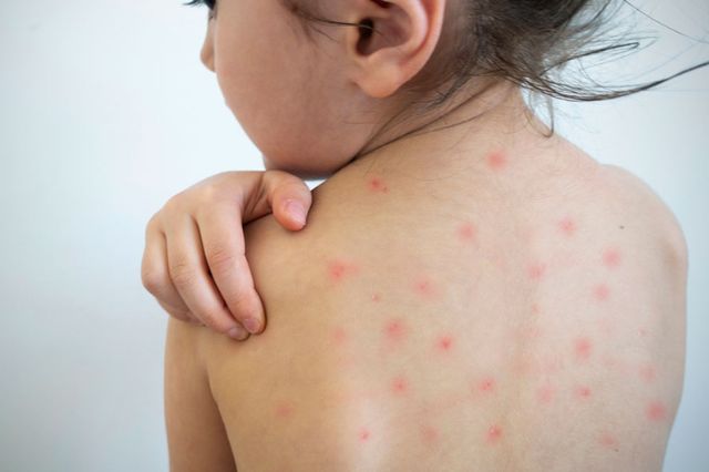 Michoacán reporta primer fallecimiento por sarampión en 2026 en México