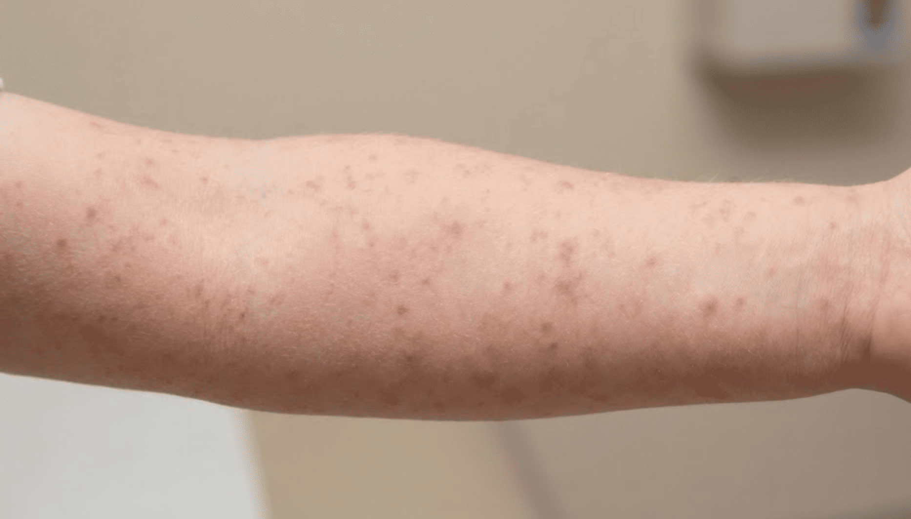 OPS alerta por repunte de sarampión en las Américas y pide reforzar la vacunación