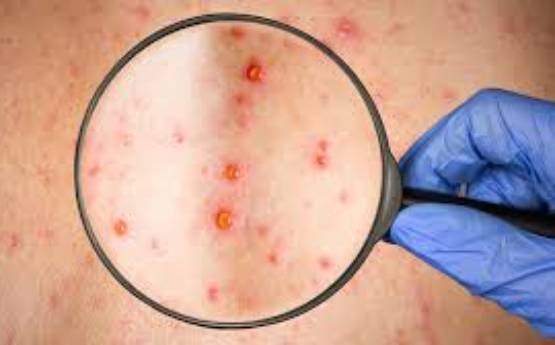 Incrementa de 159 a 179 casos probables de sarampión: 53 confirmados 