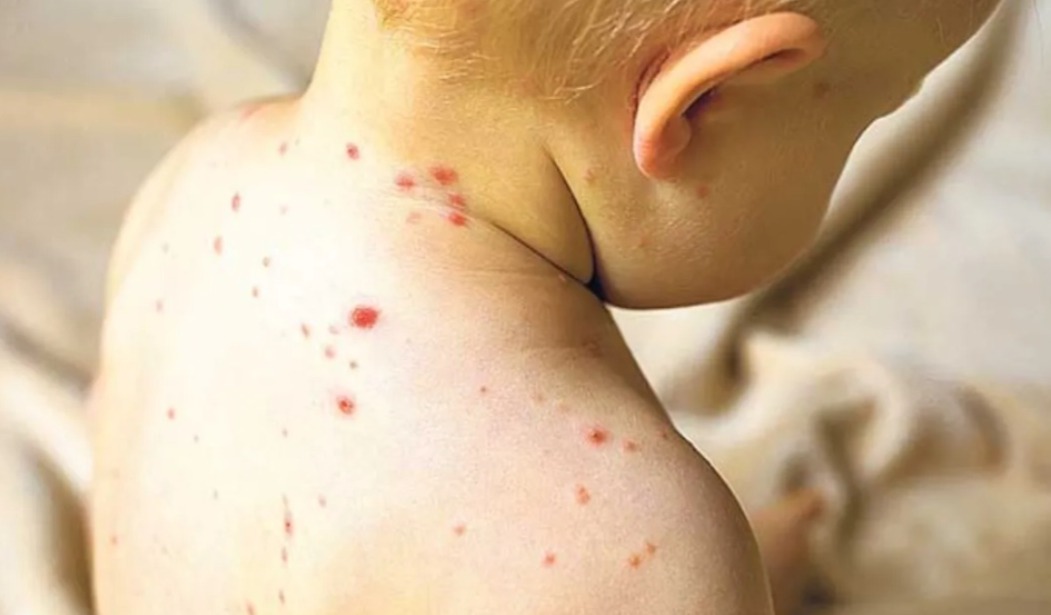 Así puedes identificar el sarampión de otros salpullidos 