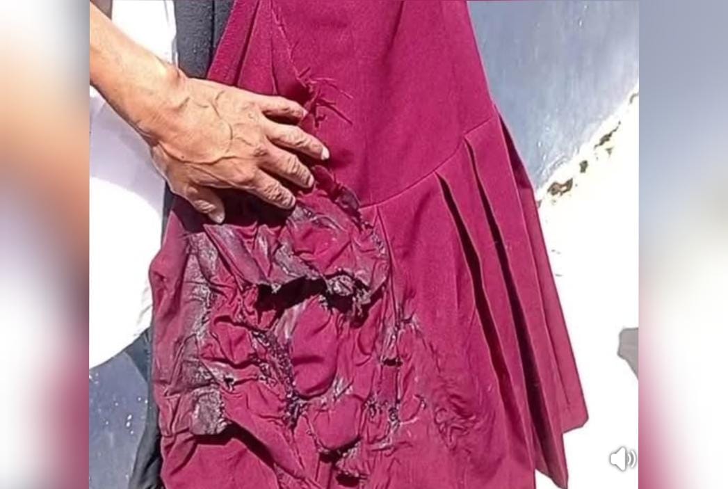 Menor resulta con quemaduras durante práctica escolar en primaria de Tehuacán