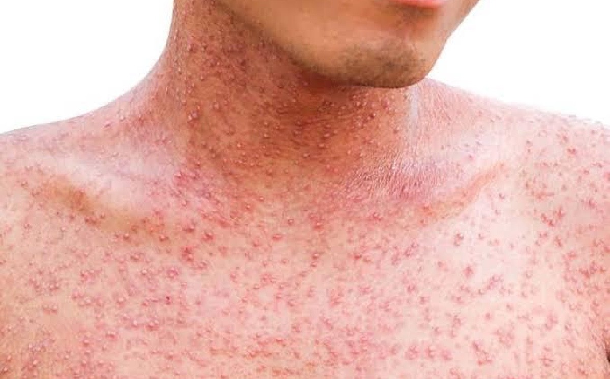 Confirman la presencia de sarampión en 10 municipios de Puebla y 102 casos activos 