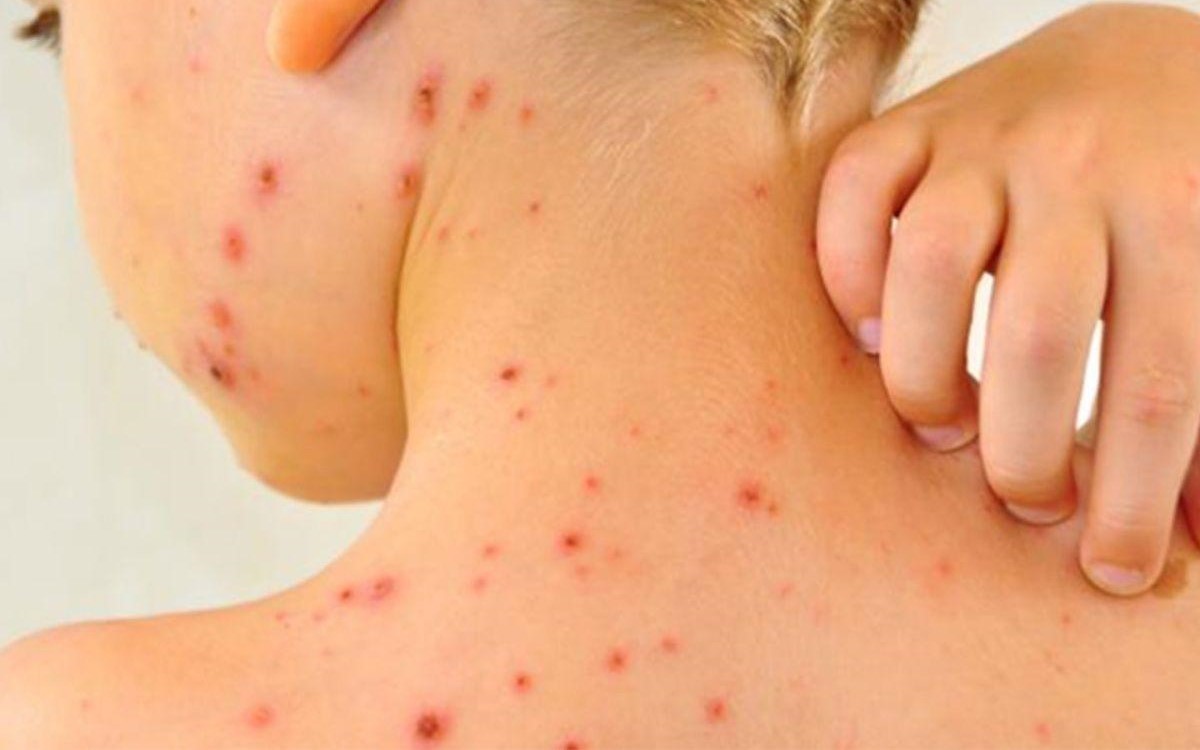 Emiten alerta epidemiológica por sarampión a días del Mundial 2026 