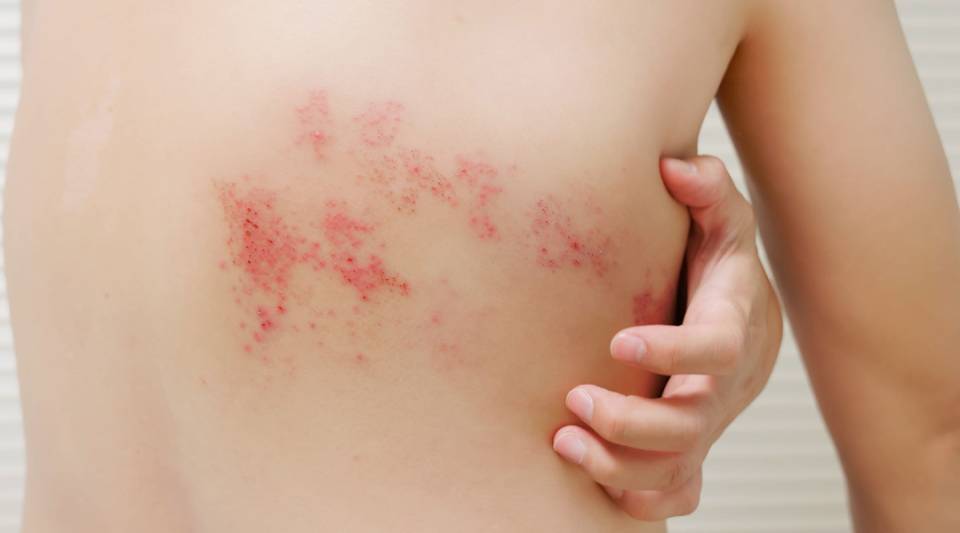 De la varicela al herpes zóster: cómo el virus puede reaparecer en adultos