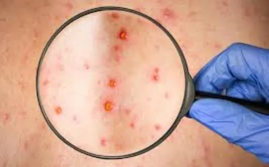 En el estado de Puebla 11 municipios presentan casos de sarampión