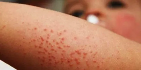 virus-coxsackie-660x330