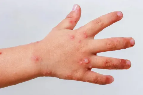 virus