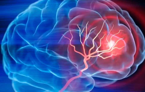 Secretaría de Salud exhorta a la población a adoptar hábitos saludables para prevenir la enfermedad del Ictus.