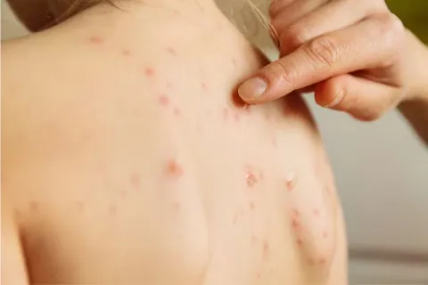 Se han aplicado 8 millones 872 mil 358 dosis de vacuna triple viral (SRP) y SR en todo el país.