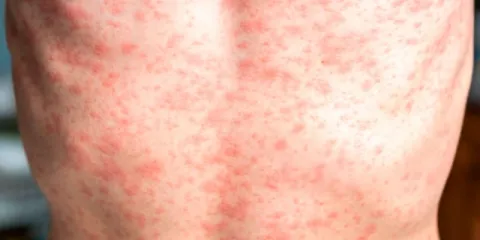 Facultad de Medicina de la Universidad Nacional Autónoma de México (UNAM) dio a conocer un caso sospechoso de sarampión.