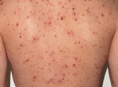 Por brote de sarampión, obligatorio uso de cubrebocas en escuelas del Edomex.