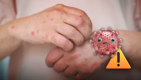 sarampion-alerta-sdp