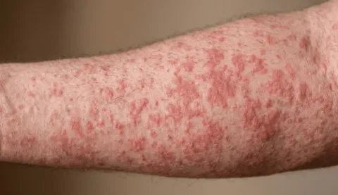 Van 202 casos de sarampión en 17 municipios poblanos.