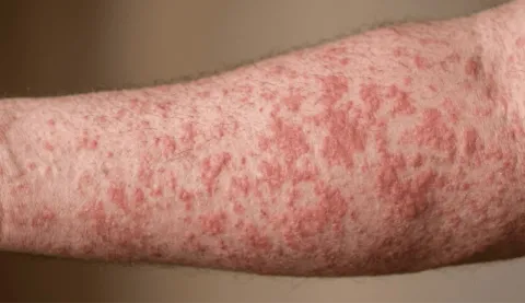 Puebla registra 186 casos de sarampión en 15 municipios.