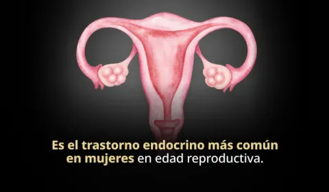 Mujeres con síndrome de ovario poliquístico, propensas a sufrir depresión y ansiedad.